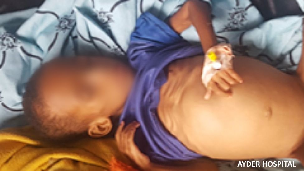 Un nen desnodrit amb tractament a l'Hospital Ayder de Mekelle